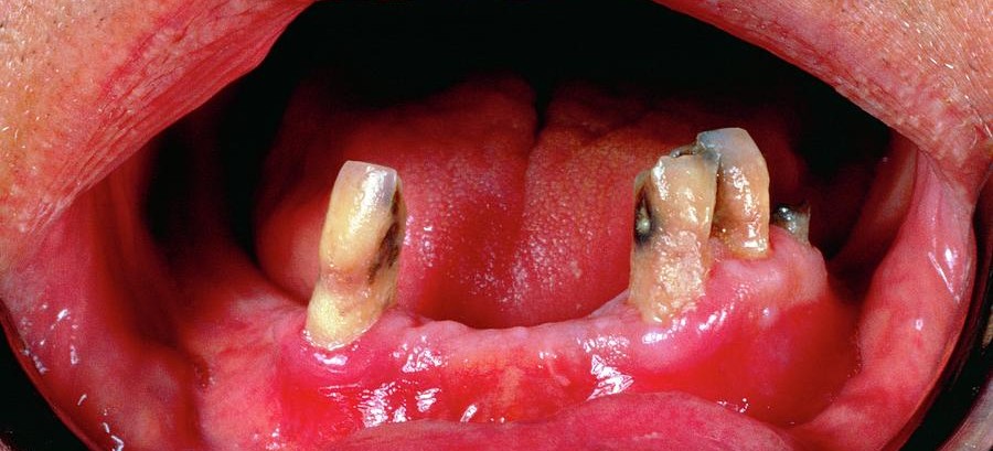 Imagem de boca de pessoa que perdeu praticamente todos os dentes e os que restaram estão danificados, devido ao escorbuto.