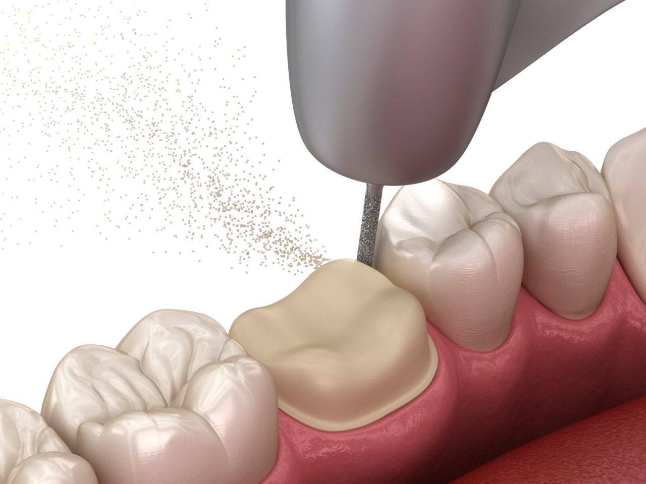 Imagem criada digitalmente mostra procedimento realizado em dente antes de colocar a coroa.