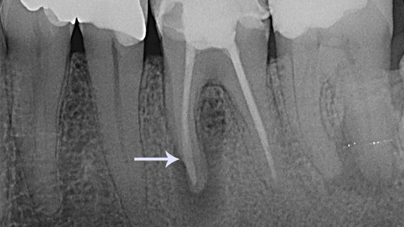 Raio-x mostra fratura na raiz