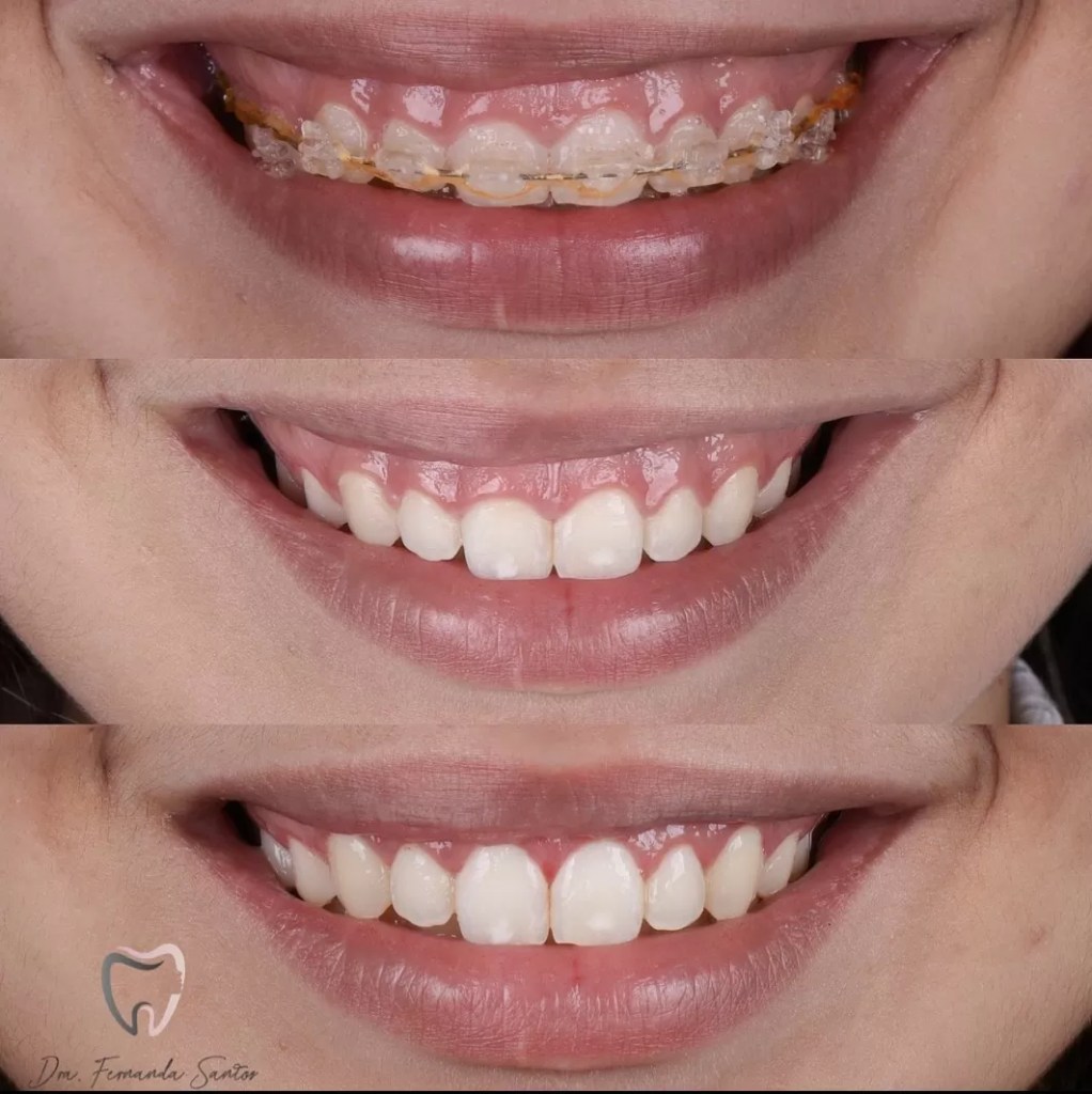 antes e depois de gengivoplastia, na primeira foto a paciente ainda está de aparelho ortodôntico