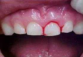 Imagem de Concussão dentária