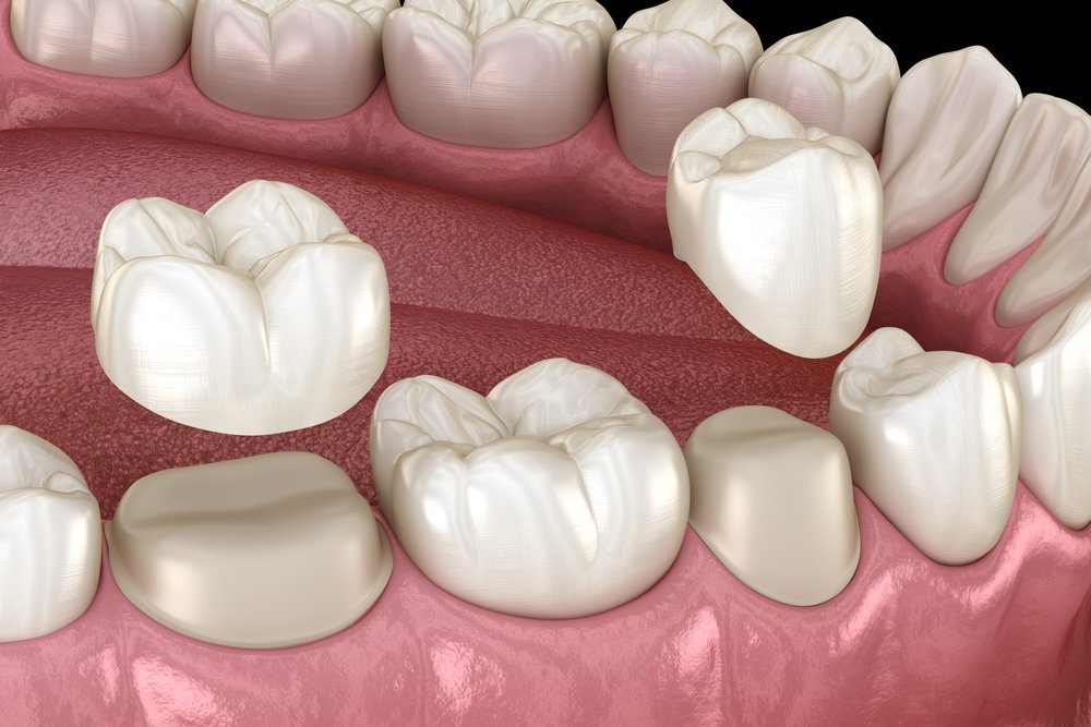 Imagem digital mostra encaixe de coroas dentárias.