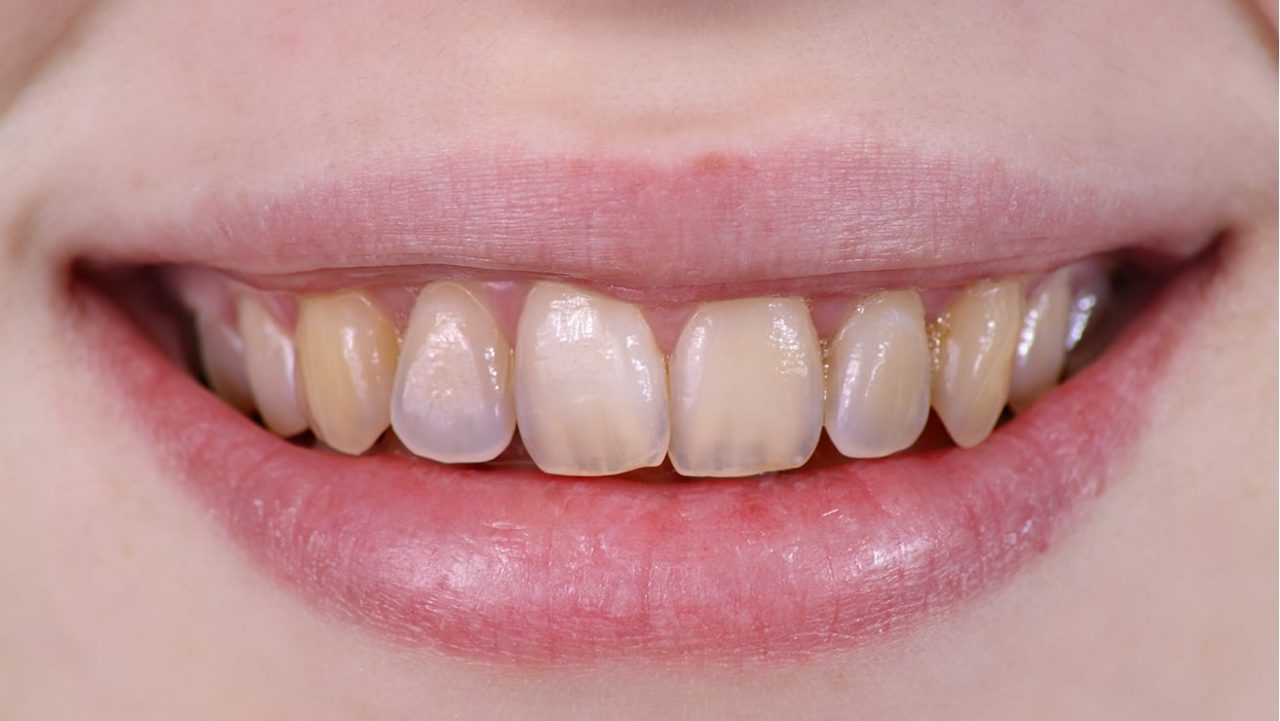 Na imagem, aparece apenas o sorrido de uma mulher que possui o esmalte do dente desgastado e amarelado.