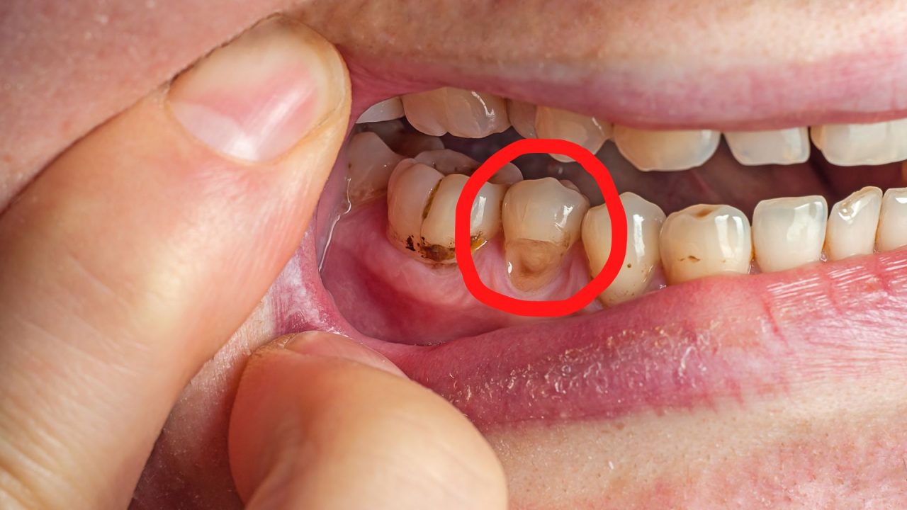Dente com desgaste severo por erosão.