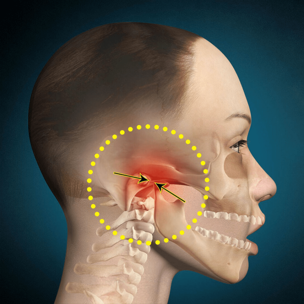 Desenho mostra onde fica a Disfunção Temporomandibular