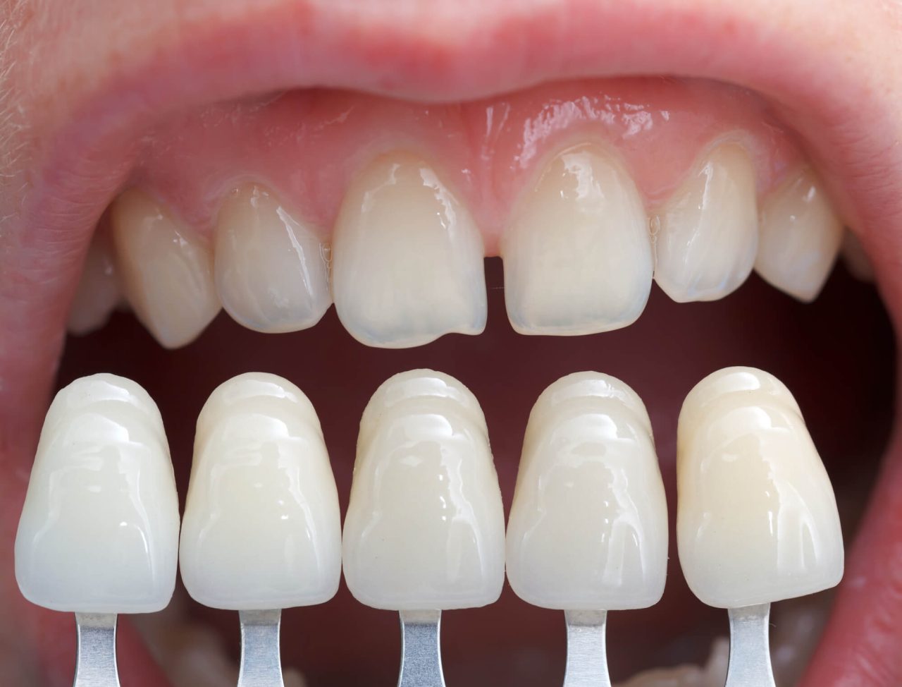 Pessoa com dentes desgastados e na frente algumas facetas dentárias para ver se é compátivel.