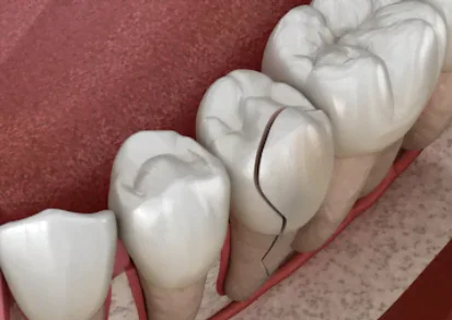 imagem criada digitalmente de dente com fratura (rachado)