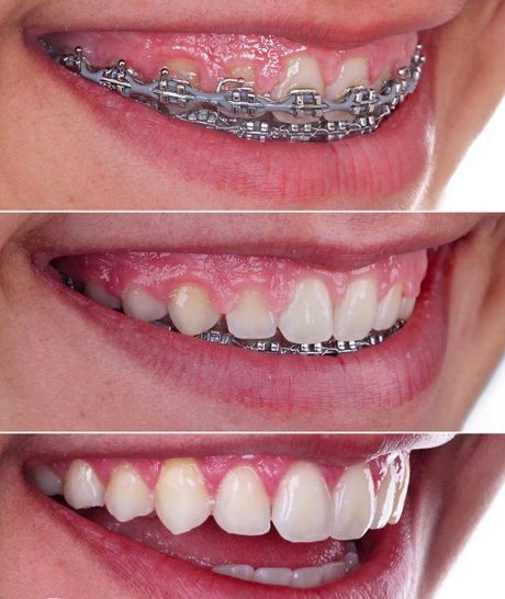 antes e depois de gengivoplastia