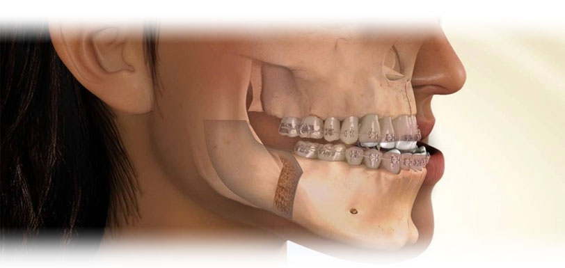 Desenho mostra pessoa e também seu crânio após cirurgia bucomaxilo.