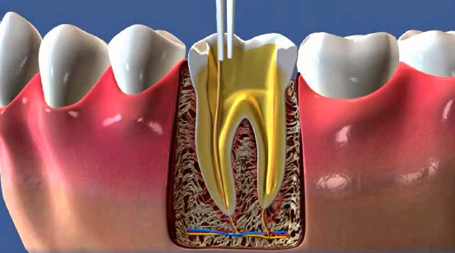 Desenho mostra uma etapa de fazer canal no dente.