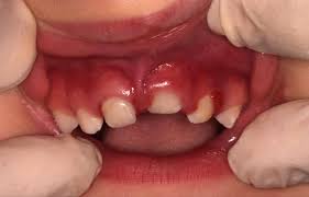 Luxação dentária intrusiva, isto é, após trauma os dentes entraram na gengiva