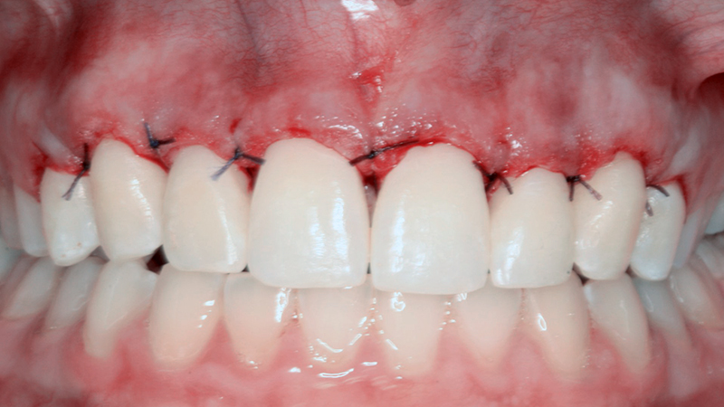 boca de paciente após gengivectomia ainda com os pontos