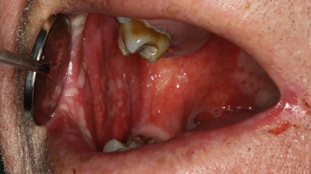 Dentista afasta com espelho a bochecha do paciente, mostrando na parede da boca dele um mucosite oral.