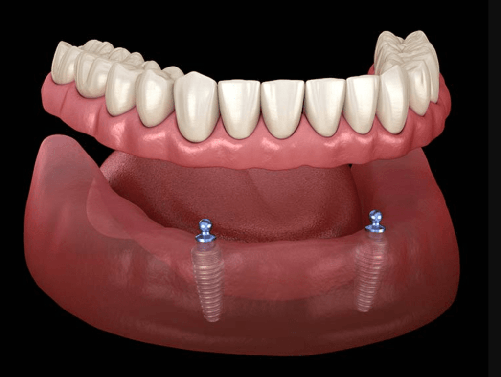 Prótese Overdenture - mostra dois implantes e a prótese que ira encaixar por cima