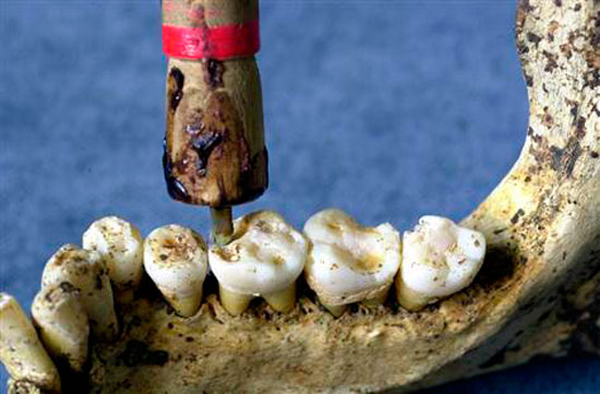 Imagem de fóssil antigo de dente com perfurações
