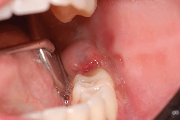 Foto de Pericoronarite