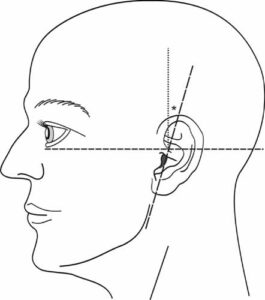 Desenho de um rosto, e ao meio tem passando um tracejado na horizontal que é o Plano de Frankfurt na Odontologia