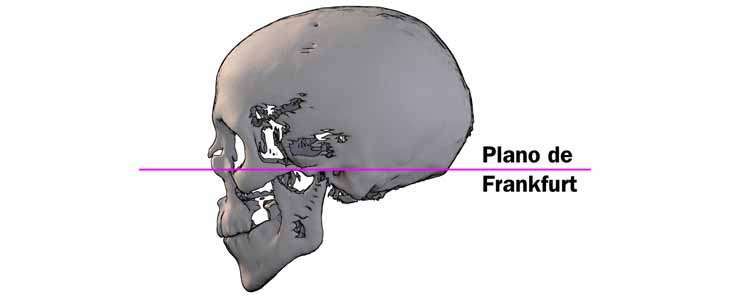 Desenho de um crânio, e ao meio tem passando uma linha roxa na horizontal e escrito Plano de Frankfurt