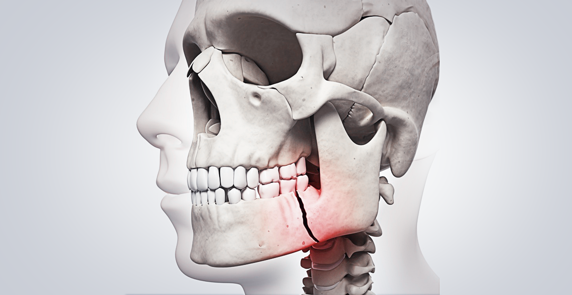 desenho de crânio com fratura na mandíbula