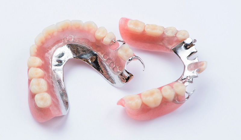 Prótese parcial metálica