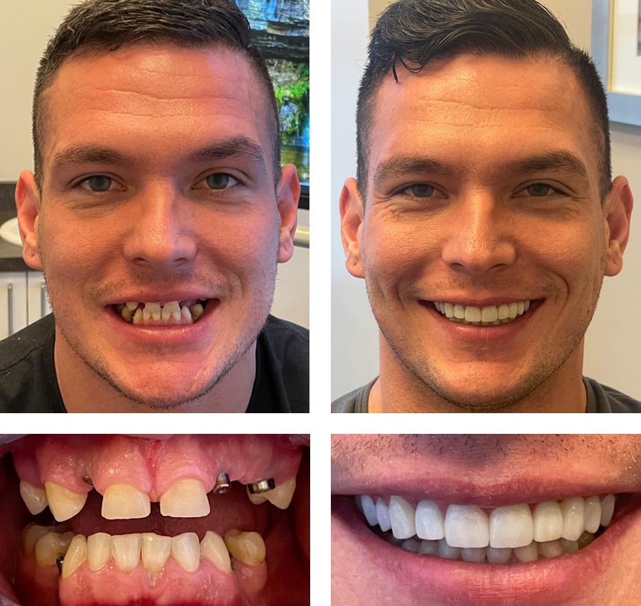 Antes e depois de homem que fez implante nos dentes.