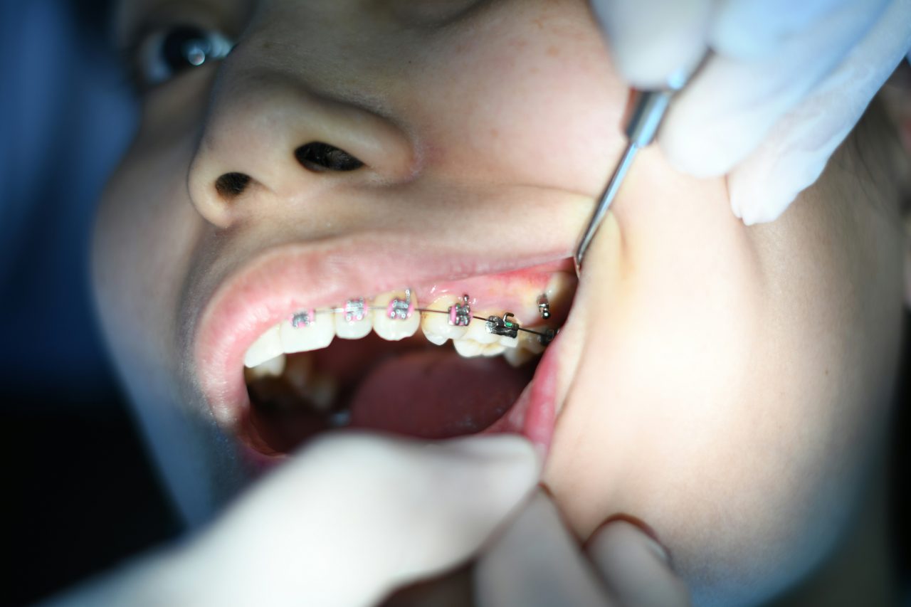 Dentista conferindo o aparelho metálico da paciente.
