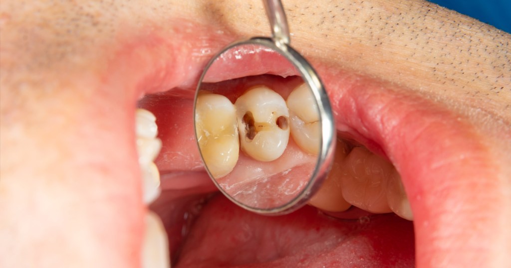 Dentista com espelhinho mostra dois buracos de cárie no dente do paciente.