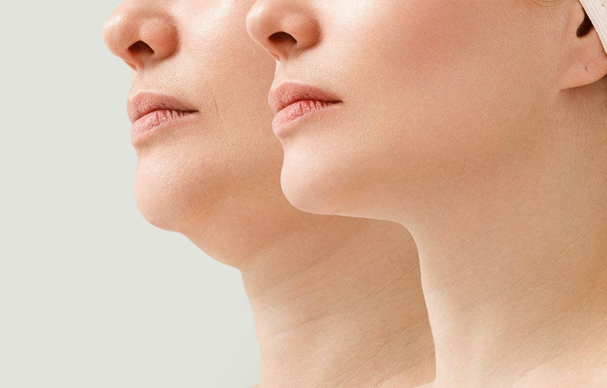 Imagem de antes e depois de lipoplastia de papada.