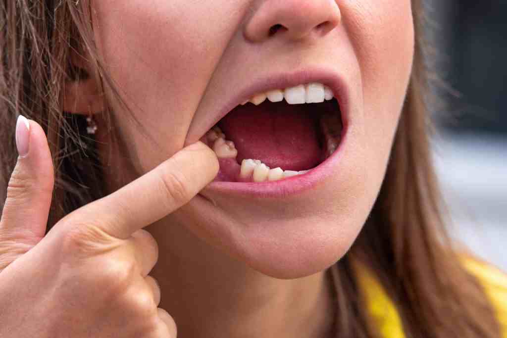 Jovem garota puxa o lábio inferior mostrando que está faltando um dente embaixo.