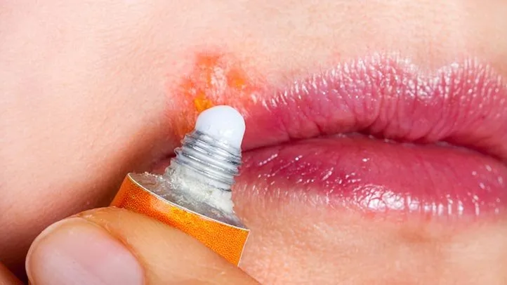 Mulher colocando pomada em herpes no lábio.