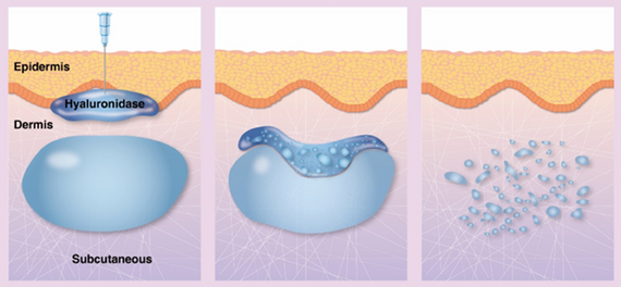 Desenho mostra como a hialuronidase age no ácido hialurônico dentro da nossa pele, dissolvendo em fragmentos menores.