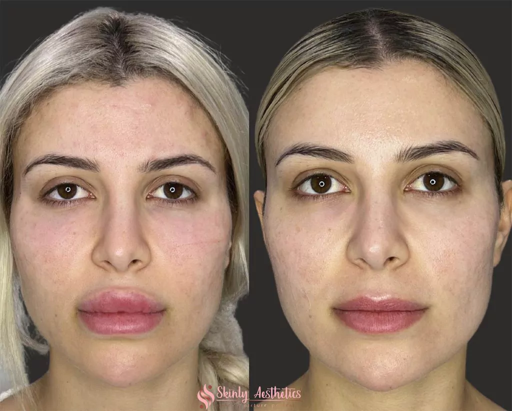 Antes e depois de ter removido excesso de preenchimento labial com a hialuronidase.