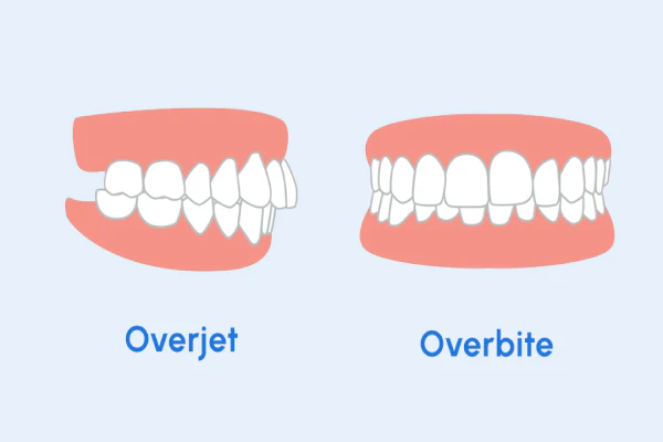Desenho mostrando a diferença de overjet e overbite.