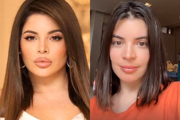 Antes e depois de influenciadora Gkay desfazer seu preenchimento labial com hialuronidase.