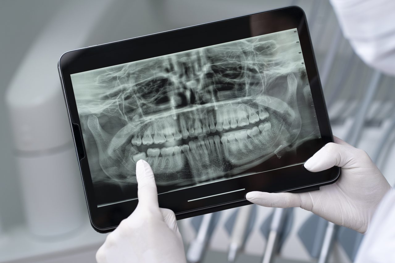 Dentista apontando para dente siso em radiografia no tablet.