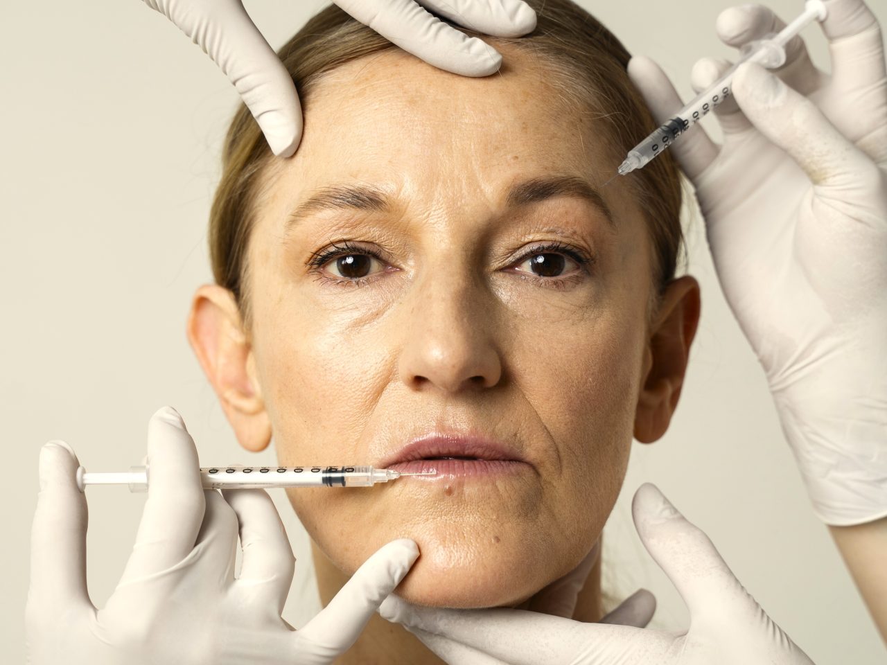 Senhora está parada enquanto duas pessoas mostram com a seringa onde será aplicado o preenchimento.