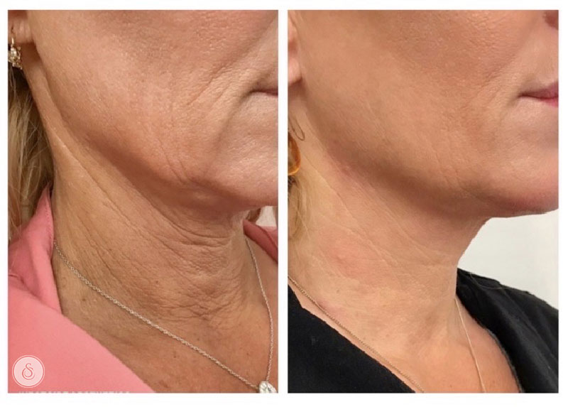 Antes e depois de senhora que passou por tratamento com bioestimuladores de colágeno no pescoço.