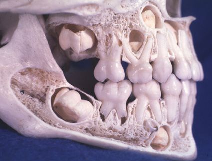 Crânio mostra como ficam os dentes de leite e os dentes permanentes esperando sair.