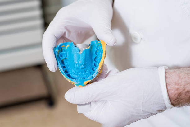 Gesso odontológico azul secando em molde.