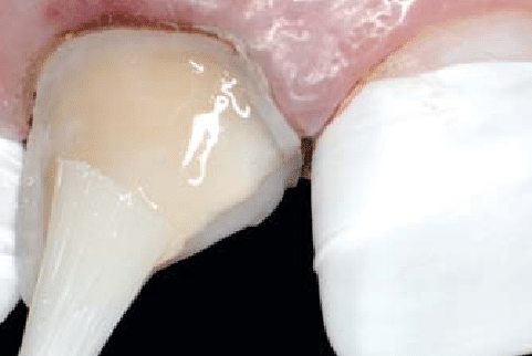 Imagem bem próxima de aplicação de adesivo dental em dente quebrado.