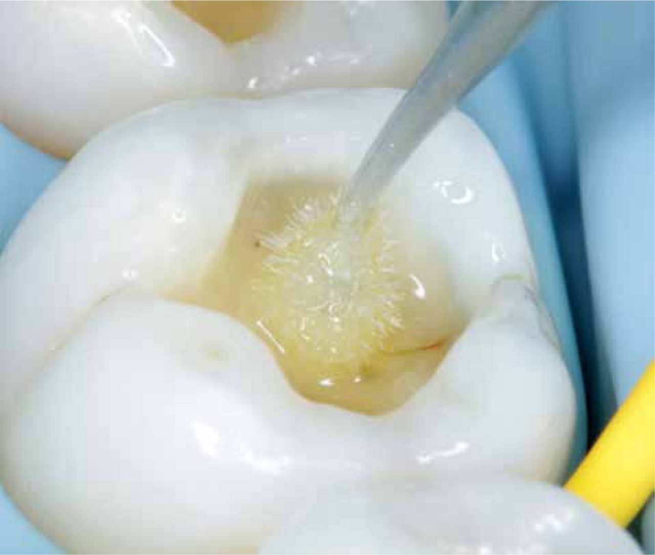 Imagem bem próxima de aplicação de adesivo odontológico.