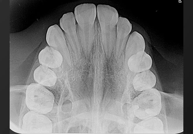 Filme Radiográfico Oclusal mostra a arcada dentária