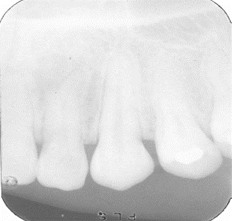 Raio-x dental com pouco contraste.