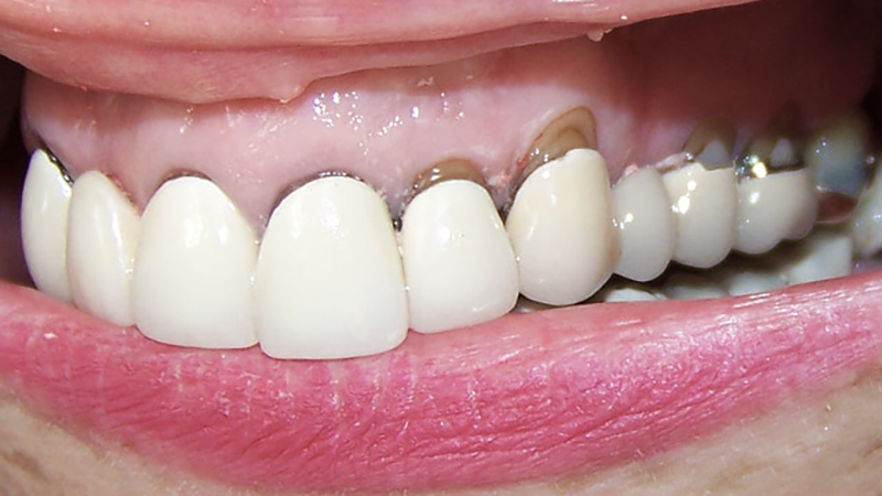 Mulher usando prótese dentária mal adaptada, que não está totalmente certa na sua boca devido a recessão gengival.