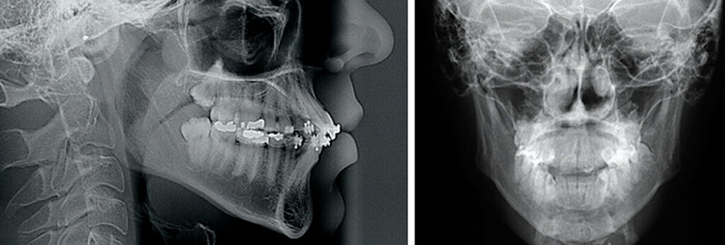 Filme Radiográfico Cefalométrico com visão de perfil e de frente.