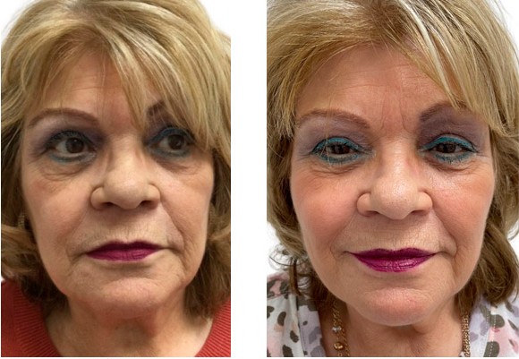 Antes e depois de senhora que fez aplicação de fios de pdo.