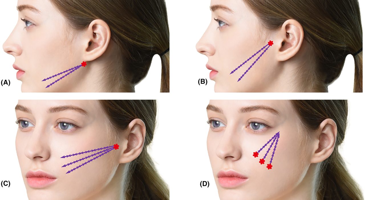 Quatro fotos mostrando por desenhos onde os fios de pdo podem ser aplicados.