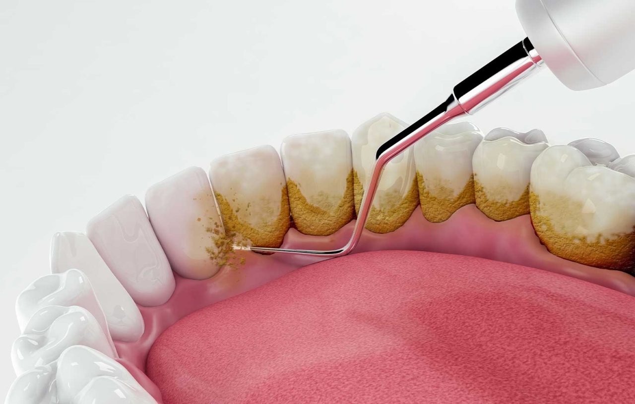 Imagem digitalmente criada mostra removendo pela profilaxia biofilme dos dentes.