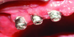 Implantes com biofilme dental.