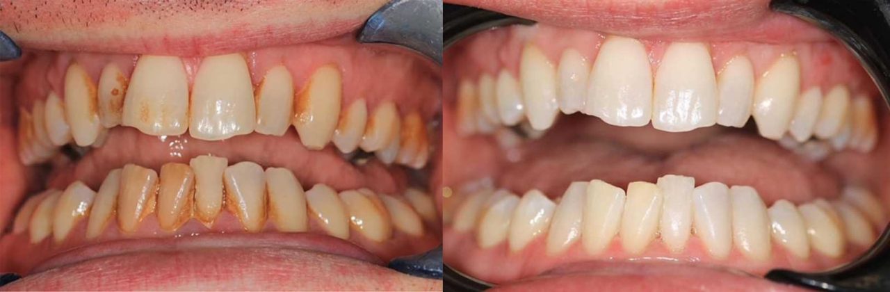 Antes e depois de limpeza de dentes com biofilme.